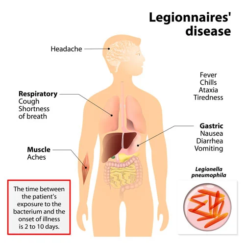 Legionnaires disease